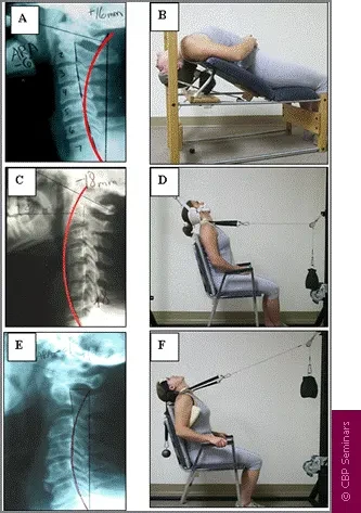 Chiropractic Durham NC Three Subluxations